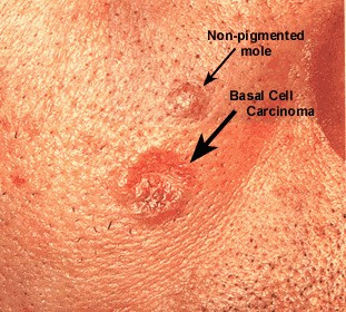 Skin Cancer Warning Signs Treatment : A Closeup View On A Brown Mole On ...
